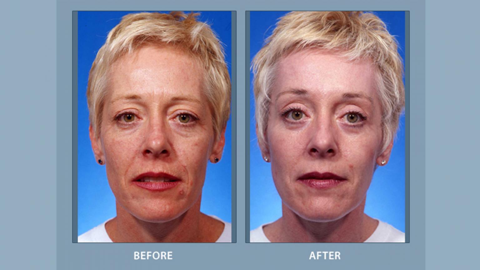 Laser Resurfacing Before And After Results Facial Cosmetic Surgery